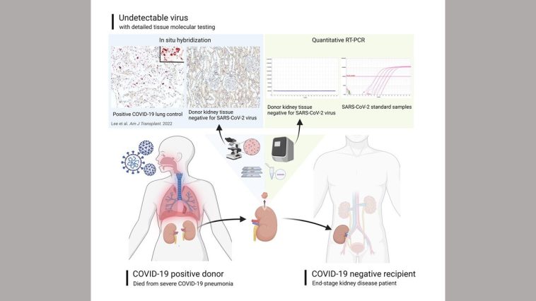 Los riñones donados de pacientes fallecidos con COVID se pueden trasplantar de manera segura | Noticias de Buenaventura, Colombia y el Mundo