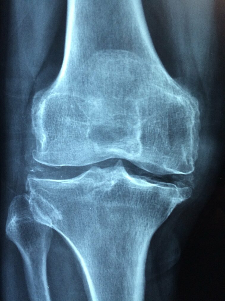 Osteoartritis: la realineación de las rodillas dañadas puede hacer que el cuerpo genere cartílago nuevamente | Noticias de Buenaventura, Colombia y el Mundo