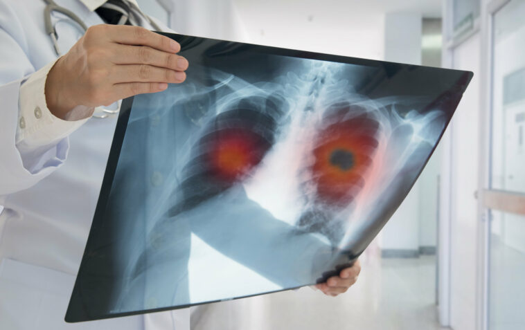 Casi la mitad de los pacientes con alto riesgo de cáncer de pulmón retrasaron el seguimiento de la detección | Noticias de Buenaventura, Colombia y el Mundo