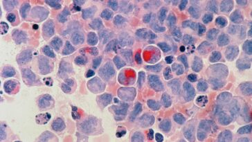 Un análisis de sangre podría predecir el riesgo futuro de leucemia, según un estudio | Noticias de Buenaventura, Colombia y el Mundo