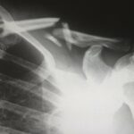 Reparación artroscópica del manguito rotador con y sin acromioplastia en el tratamiento de desgarros de espesor total del manguito rotador | Noticias de Buenaventura, Colombia y el Mundo