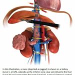 La cirugía robótica de cáncer de riñón muestra resultados deseables en un estudio | Noticias de Buenaventura, Colombia y el Mundo