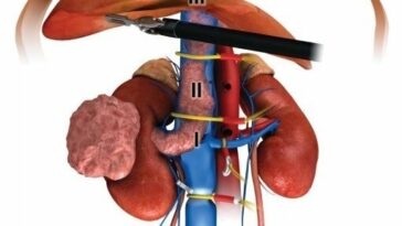 La cirugía robótica de cáncer de riñón muestra resultados deseables en un estudio | Noticias de Buenaventura, Colombia y el Mundo