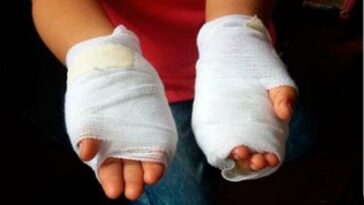 Mujer quemó las manos a su hija de 3 años como castigo en corregimiento La Playa, Atlántico  | Noticias de Buenaventura, Colombia y el Mundo