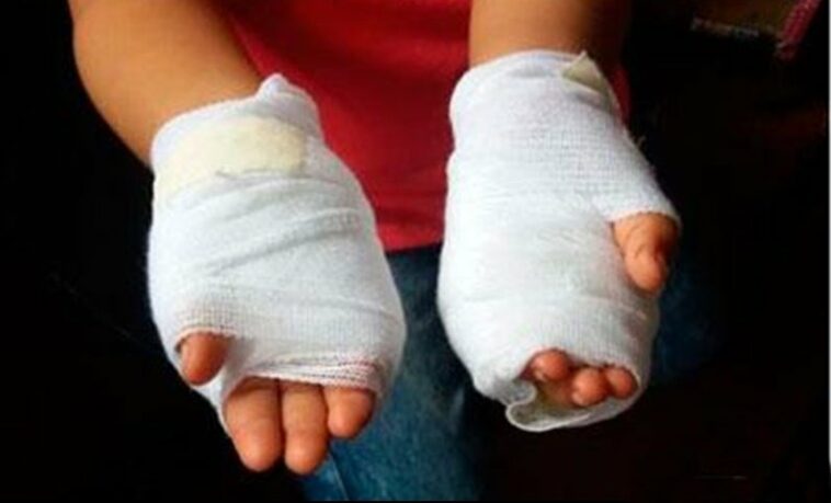 Mujer quemó las manos a su hija de 3 años como castigo en corregimiento La Playa, Atlántico  | Noticias de Buenaventura, Colombia y el Mundo