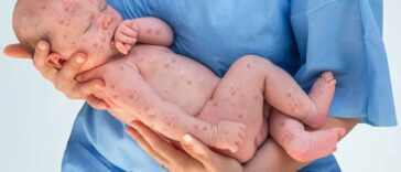 Brote de sarampión: sepa cómo proteger a los niños de esta enfermedad contagiosa | Noticias de Buenaventura, Colombia y el Mundo
