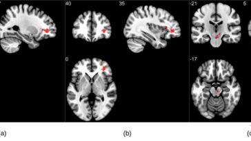 La resonancia magnética revela anomalías cerebrales significativas después de COVID | Noticias de Buenaventura, Colombia y el Mundo