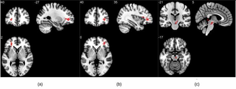 La resonancia magnética revela anomalías cerebrales significativas después de COVID | Noticias de Buenaventura, Colombia y el Mundo