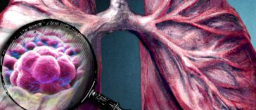 El perfil de matriz tumoral da pistas sobre la progresión de algunos cánceres de pulmón | Noticias de Buenaventura, Colombia y el Mundo