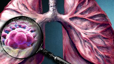 El perfil de matriz tumoral da pistas sobre la progresión de algunos cánceres de pulmón | Noticias de Buenaventura, Colombia y el Mundo