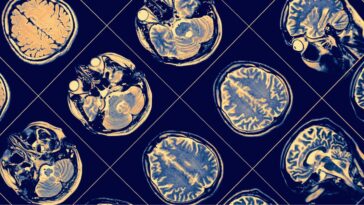 Se observa un 'adelgazamiento' cerebral similar en adultos mayores con obesidad y personas con Alzheimer | Noticias de Buenaventura, Colombia y el Mundo