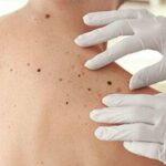 Mayor riesgo de cáncer de piel en adultos con dermatitis atópica | Noticias de Buenaventura, Colombia y el Mundo