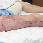 Las 'horribles' quemaduras de un hombre después de que explota un vaporizador | Noticias de Buenaventura, Colombia y el Mundo